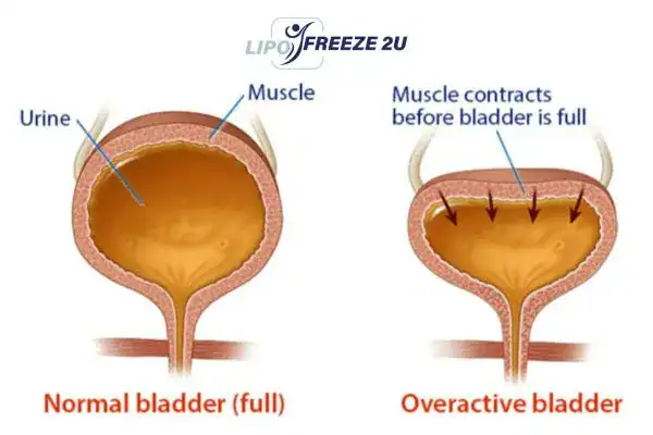 diagram of overactive bladder treatment Whitby