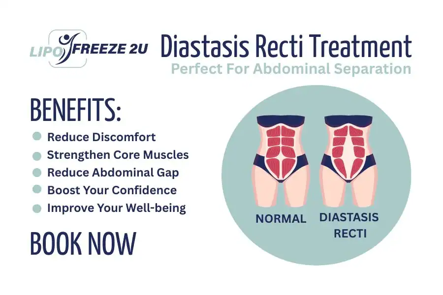 How Long Will It Take to See Improvements in Diastasis Recti Whitby