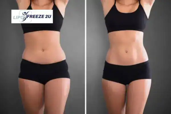 How Can LIPO FREEZE 2U Support Your Post-Pregnancy Body Recovery Whitby?