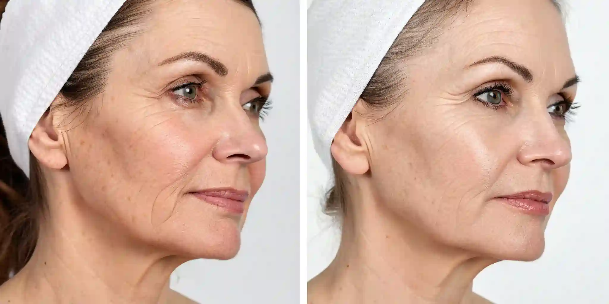 Common Questions About RF Microneedling and Loose Skin Whitby