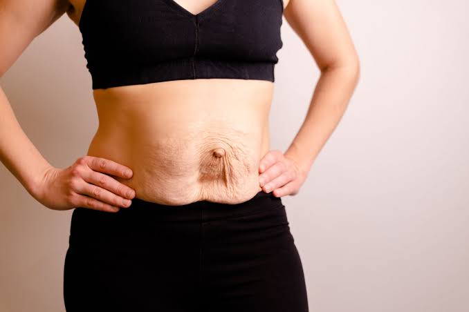 Is Surgery Really the Only Way to Repair Diastasis Recti Whitby?