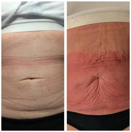 How Does RF Microneedling Improve Crepey, Thin and Uneven Skin Texture Whitby?