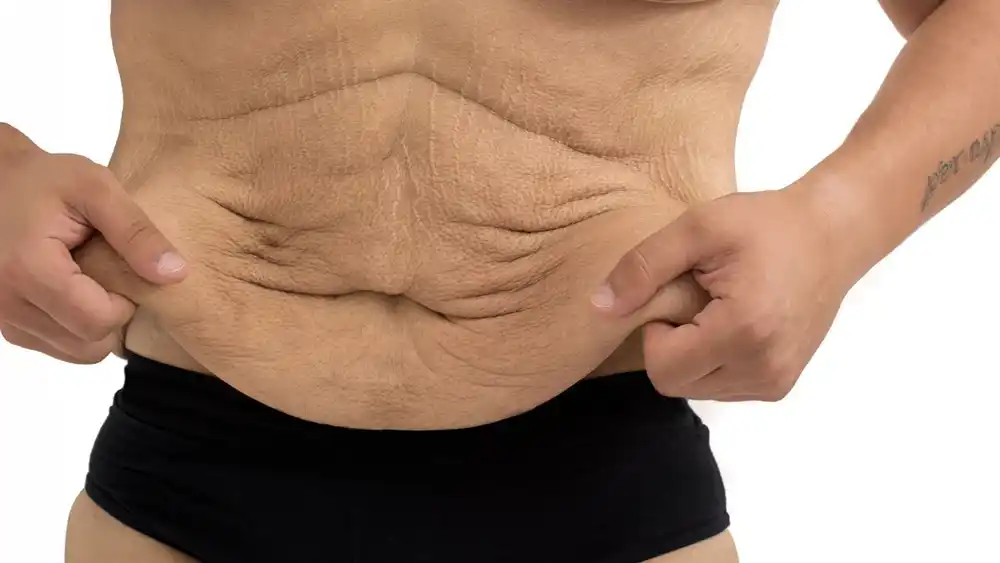 Why Does Weight Loss Medication Leave Some People With Loose or Sagging Skin Whitby?